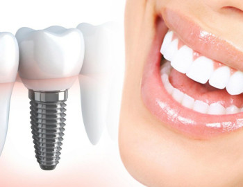 Dental implantation