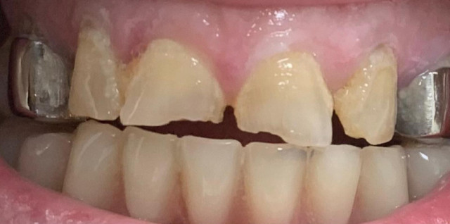 Composite dental restoration