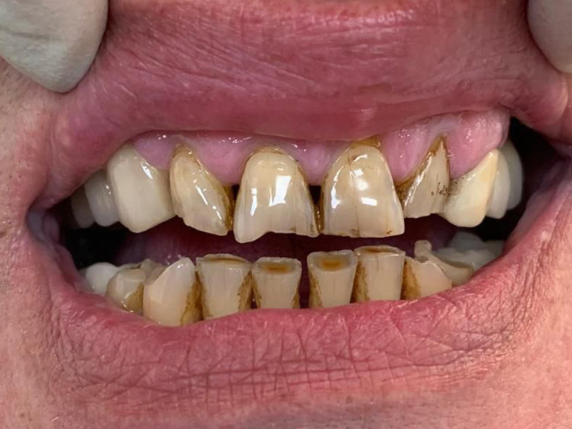 Composite dental restoration