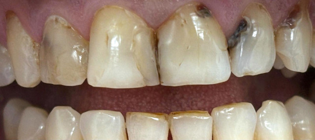 Эстетическая реставрация зубов 