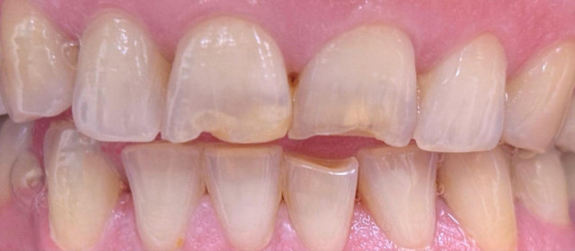 Zirconia crowns