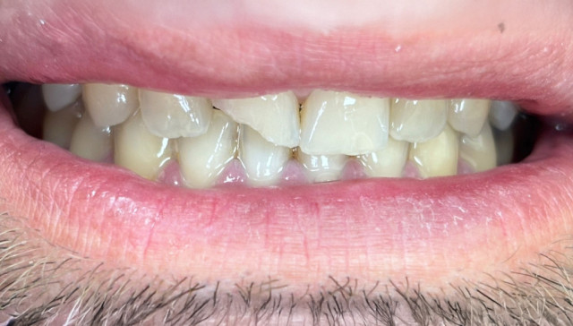 Fractured crown of the upper central incisor