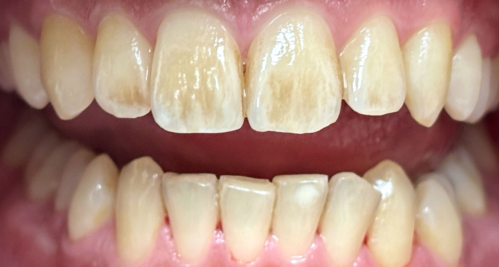 Профессиональная гигиена полости рта