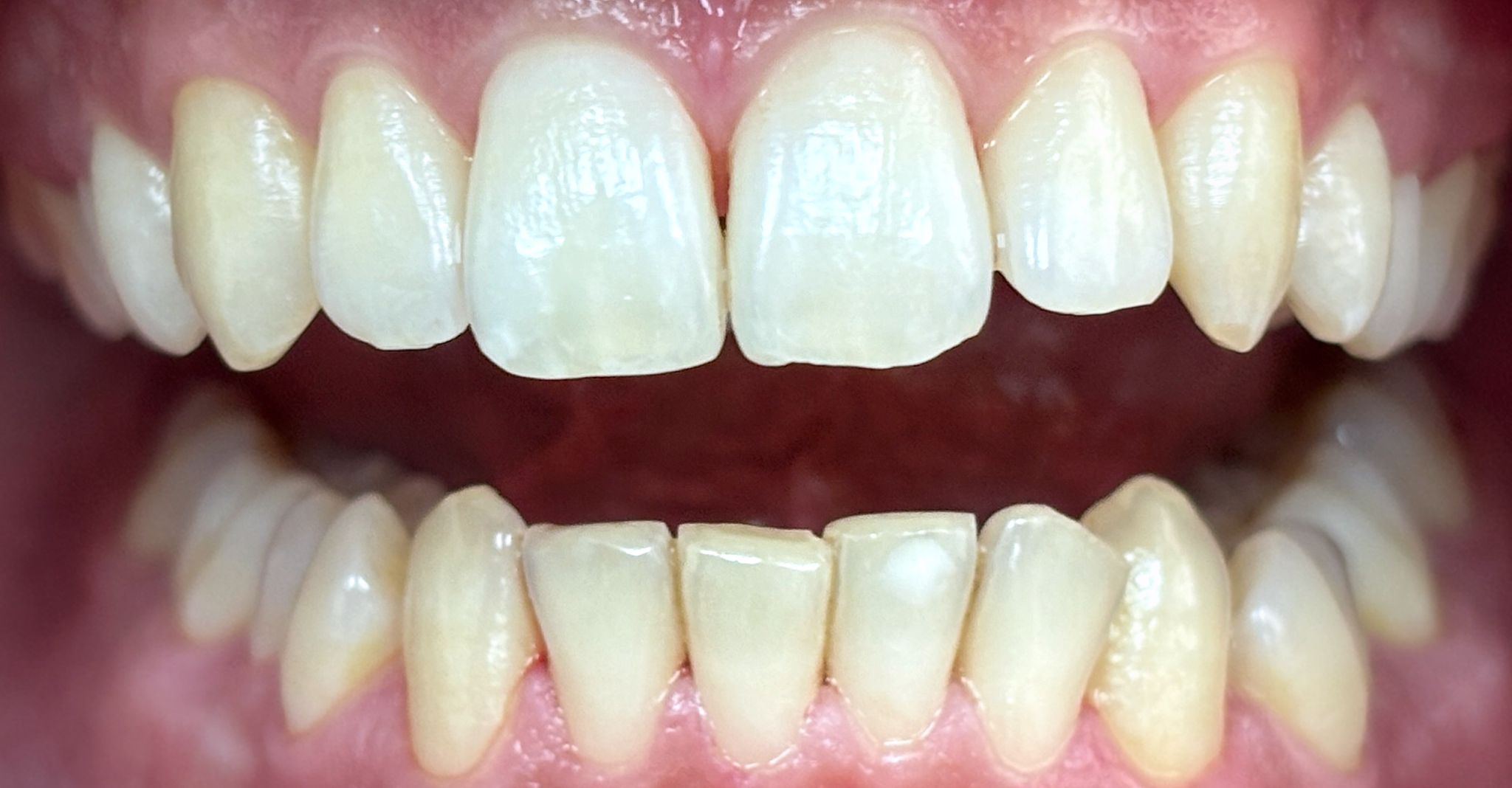 Профессиональная гигиена полости рта